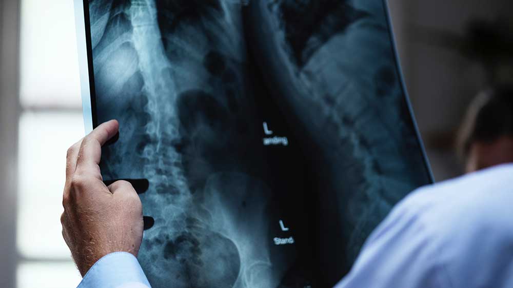 Lower and upper cross syndromes are syndromes can decrease strength, flexibility, and range of motion - what can you do to protect your spine?