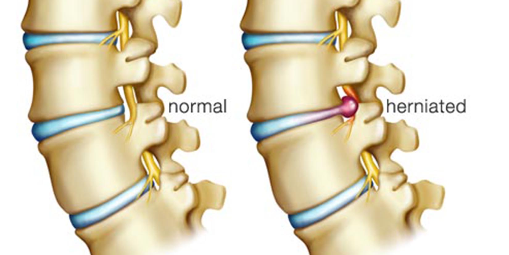 herniated disc