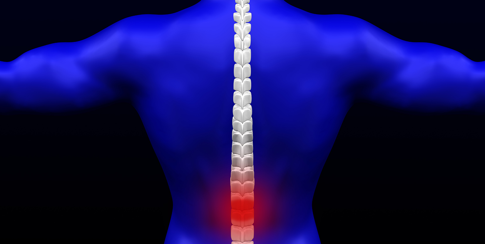 spinal stenosis